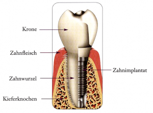 Schnittbild eines Implantates im Kieferknochen